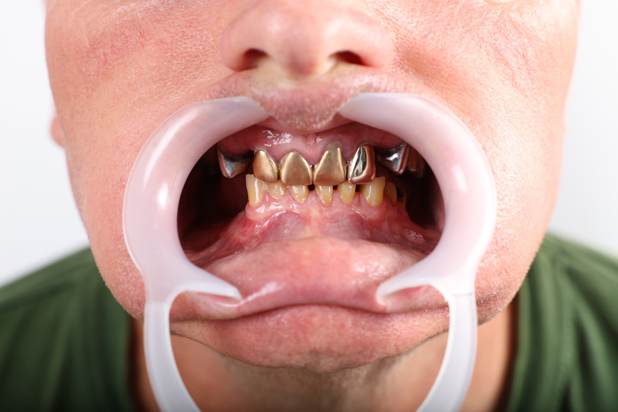 Before All-on-6 Implant Treatment